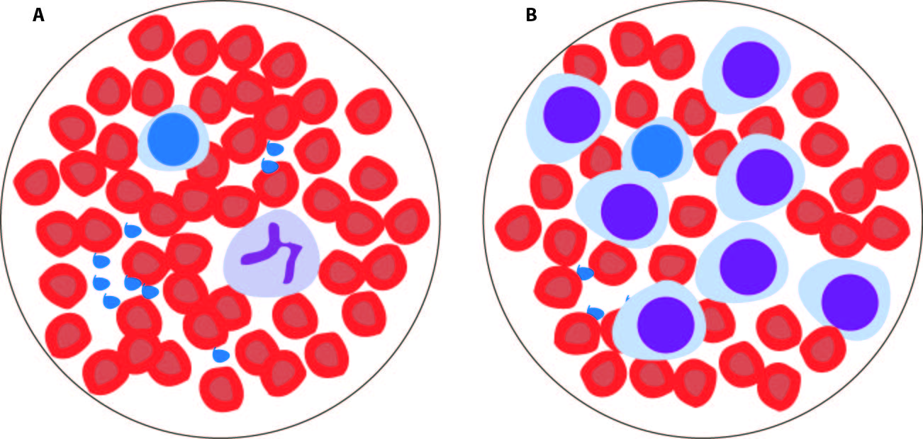 Illustration of blood cells as seen under the microscope. Panel A shows normal blood, with a majority of red blood cells. Panel B shows leukemic blood, with abundant progenitor-like leukemic cells.