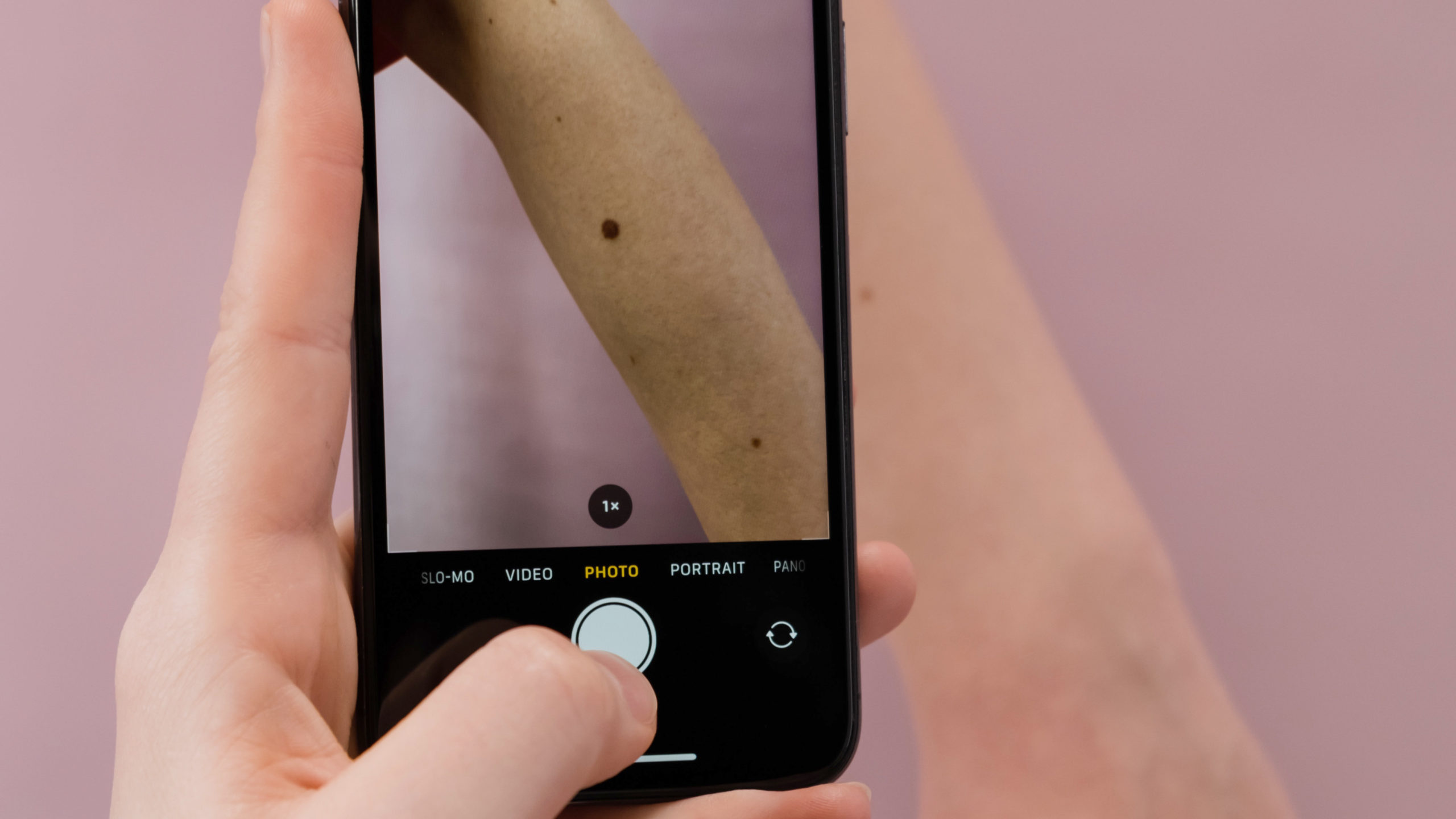 Amb l'algoritme dissenyat per la Núria González es pot detectar amb elevada eficiència si la imatge d'una lesió a la pell es correspon a un melanoma o no. Credit: Pexels, Cottonbro