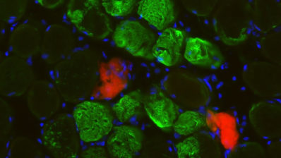Manchas verdes y rojas de fibras musculares rodeadas de pequeñas manchas azules que representan el núcleo de células musculares multinucleadas.