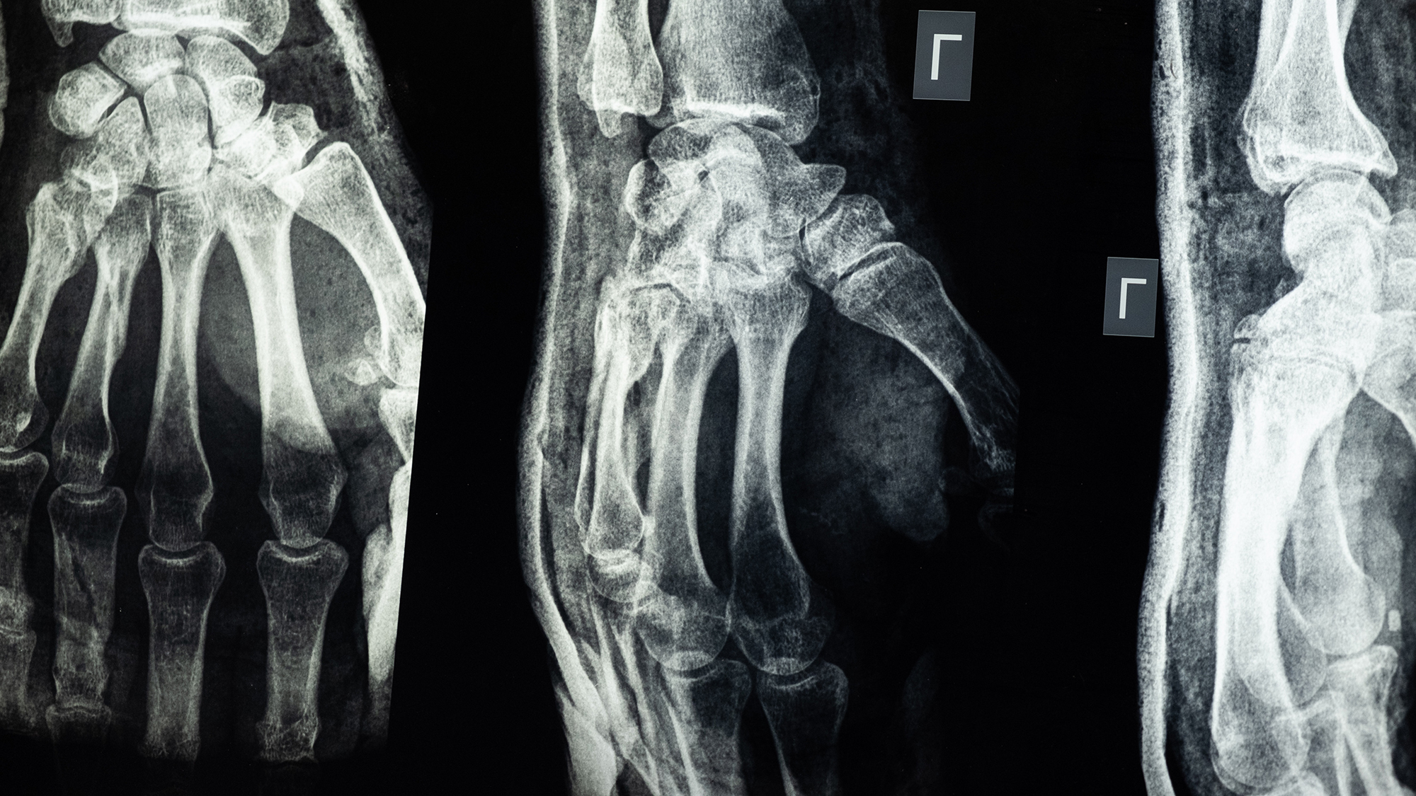 Three x-rays of one hand.