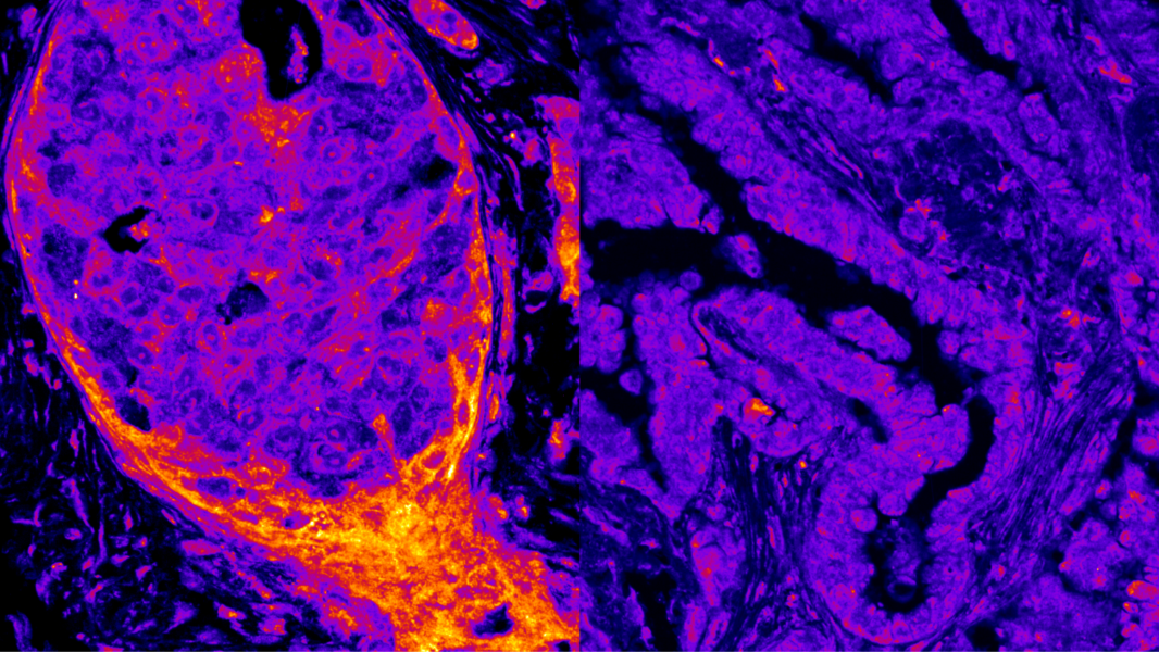 Visual comparison between breast and lung cancer cells showing differences in the nuclear levels of enzymes related to energy production.