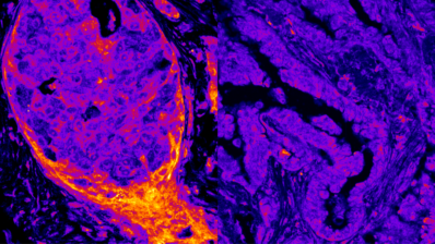 Comparación visual entre células de cáncer de mama y de pulmón que muestra diferencias en los niveles nucleares de enzimas relacionadas con la producción de energía.